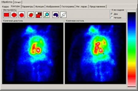 Отечественный двухдетекторный однофотонный гамма-томограф Эфатом разработки АО НИИЭФА Медицина и Фармацевтика
