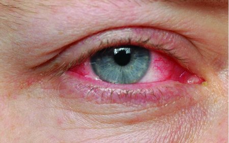 Учёные: Причиной глаукомы может быть аутоиммунное расстройство